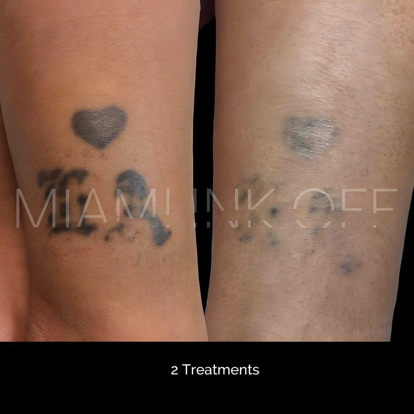 Inner-knee lettering and heart tattoo faded after two laser tattoo removal sessions at Miami Ink Off, Brickell.