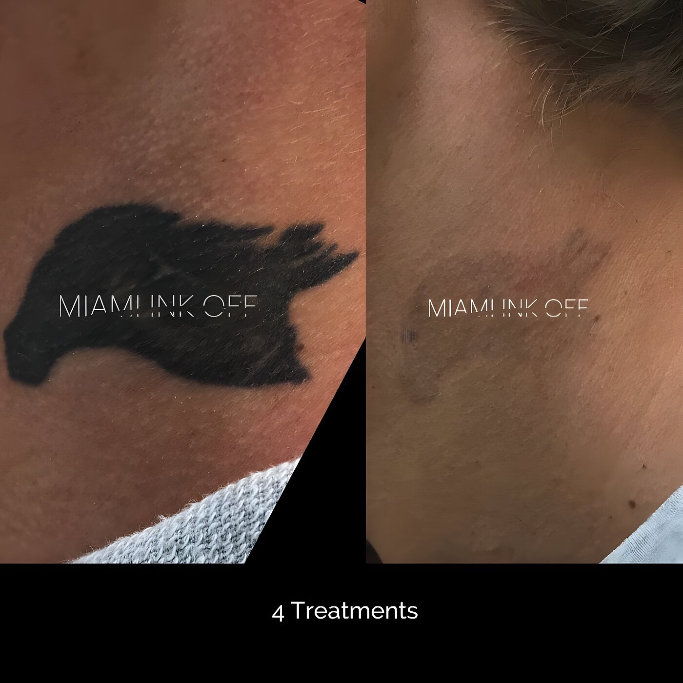 Solid black bird neck tattoo cleared after four laser tattoo removal sessions at Miami Ink Off, Brickell.