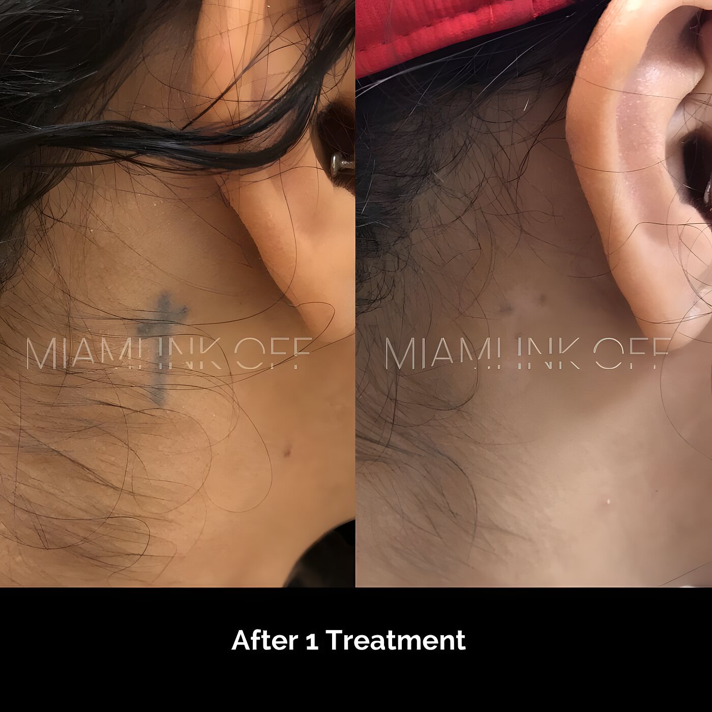Behind-the-ear cross tattoo faded after one laser tattoo removal session at Miami Ink Off, Brickell.