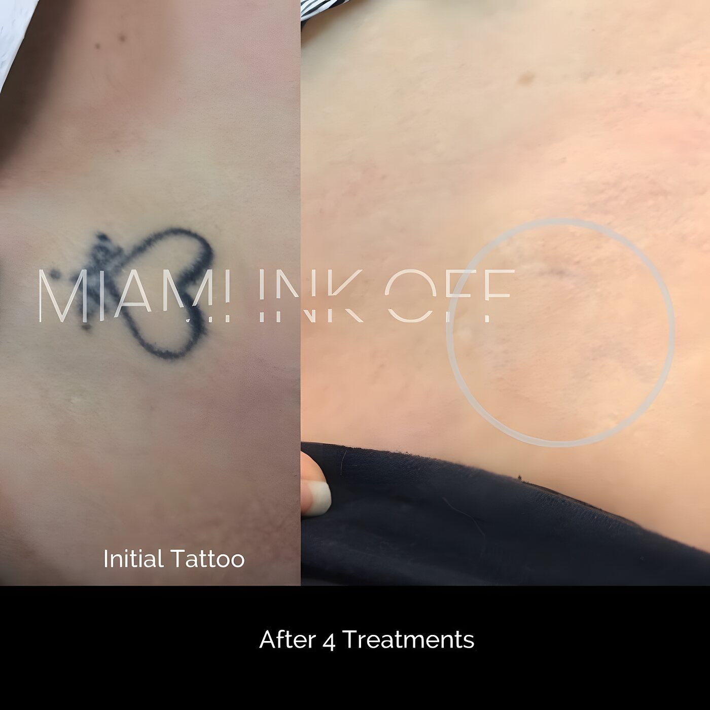 Small neck infinity tattoo nearly cleared after four laser tattoo removal sessions at Miami Ink Off, Brickell.