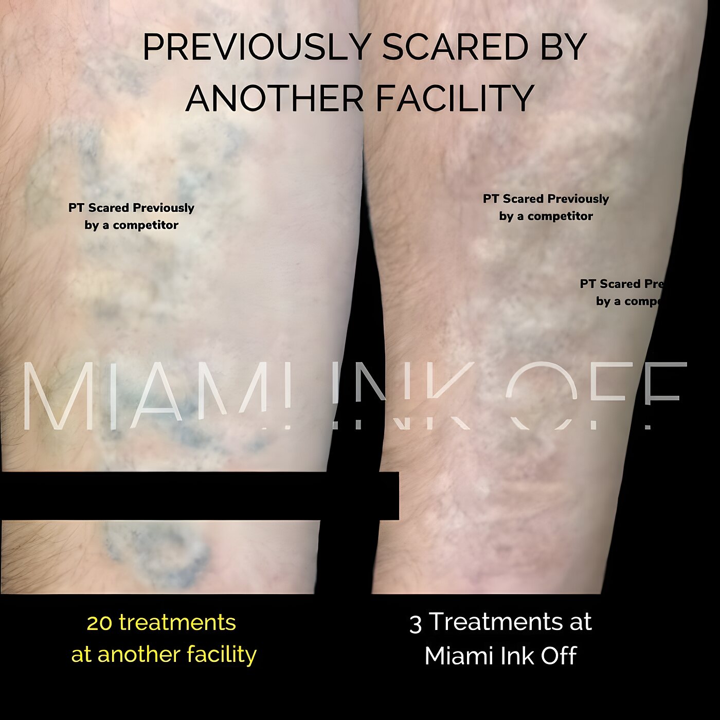 Forearm tattoo with comparable clearance in 3 sessions at Miami Ink Off versus 20 sessions at another facility, Brickell.
