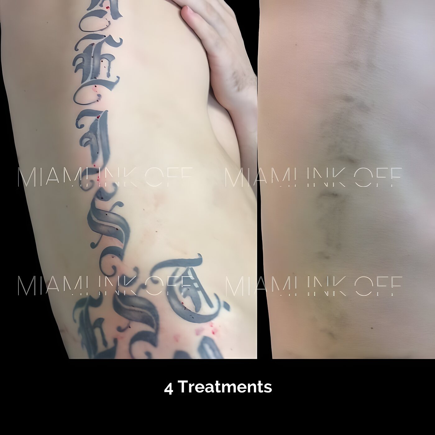 Old-English ribs lettering tattoo cleared after four laser tattoo removal sessions at Miami Ink Off, Brickell.