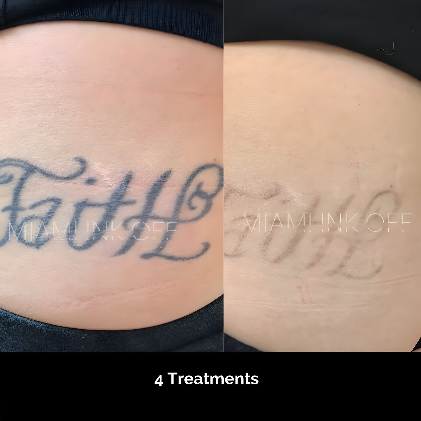 Lower-stomach script tattoo cleared after four laser tattoo removal sessions at Miami Ink Off, Brickell.