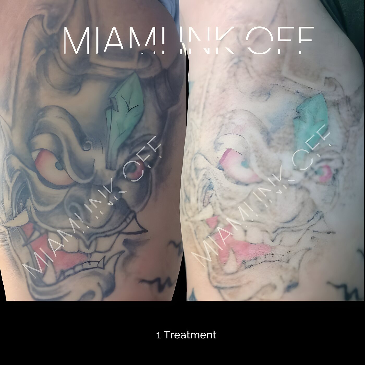 Color Japanese hannya mask tattoo lightening after one laser tattoo removal session at Miami Ink Off, Brickell.