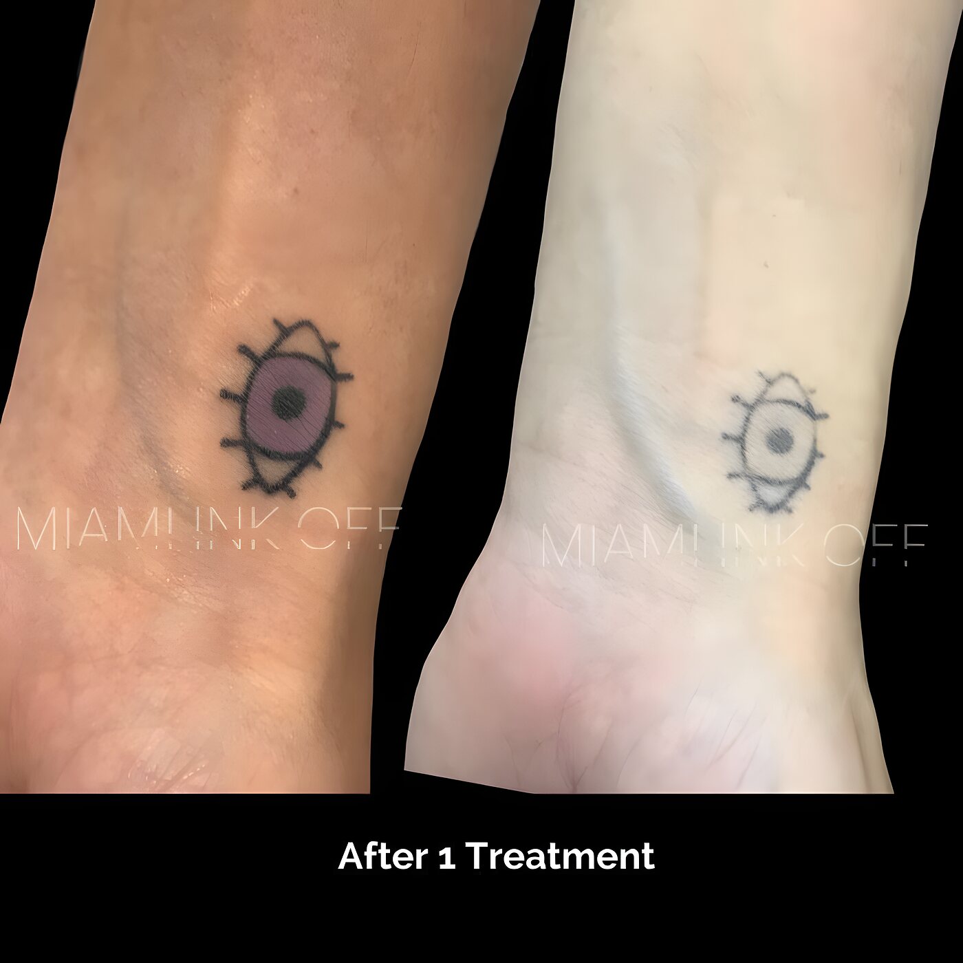 Inner-wrist tattoo dramatically faded after one laser tattoo removal session at Miami Ink Off, Brickell.