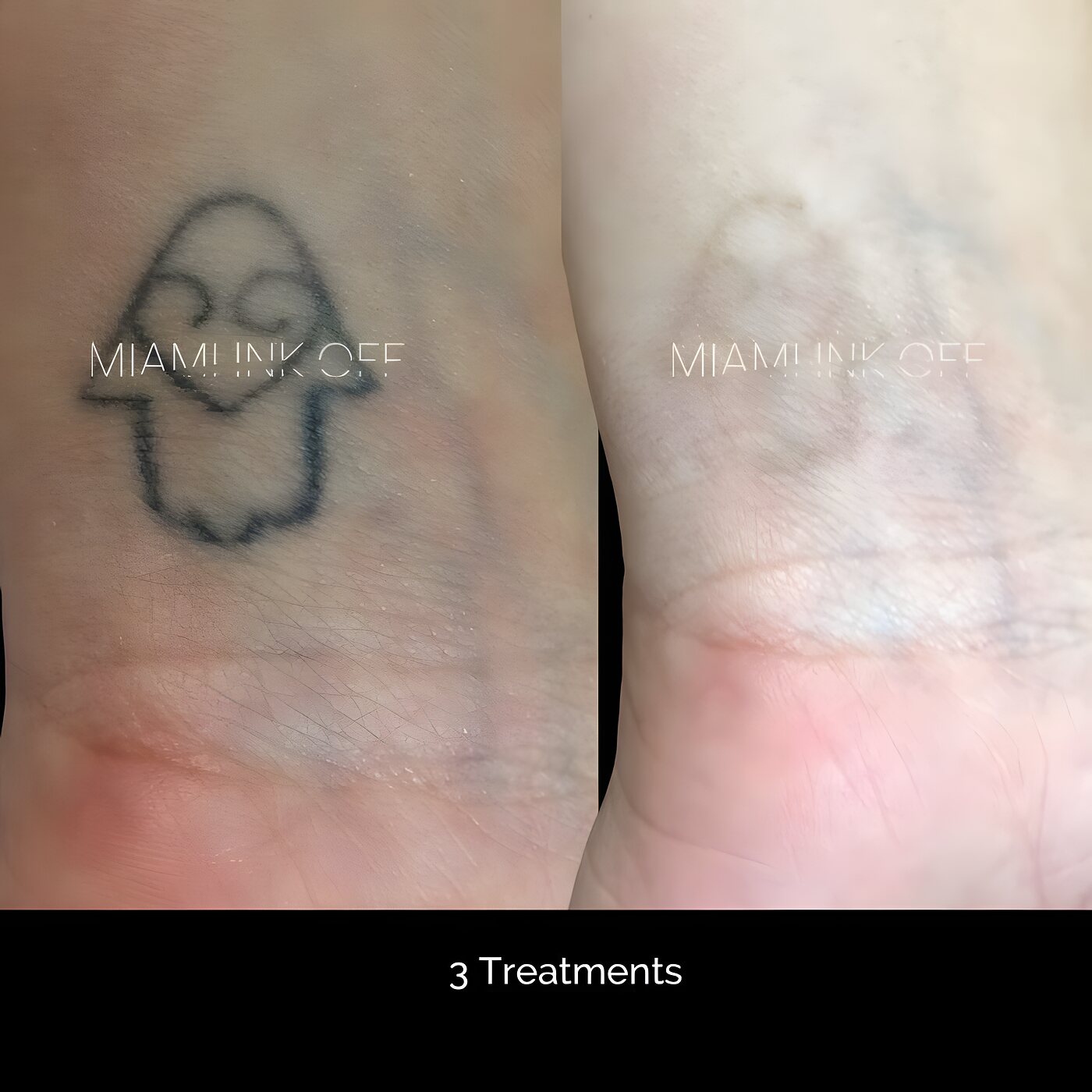 Wrist outline tattoo cleared after three laser tattoo removal sessions at Miami Ink Off, Brickell.