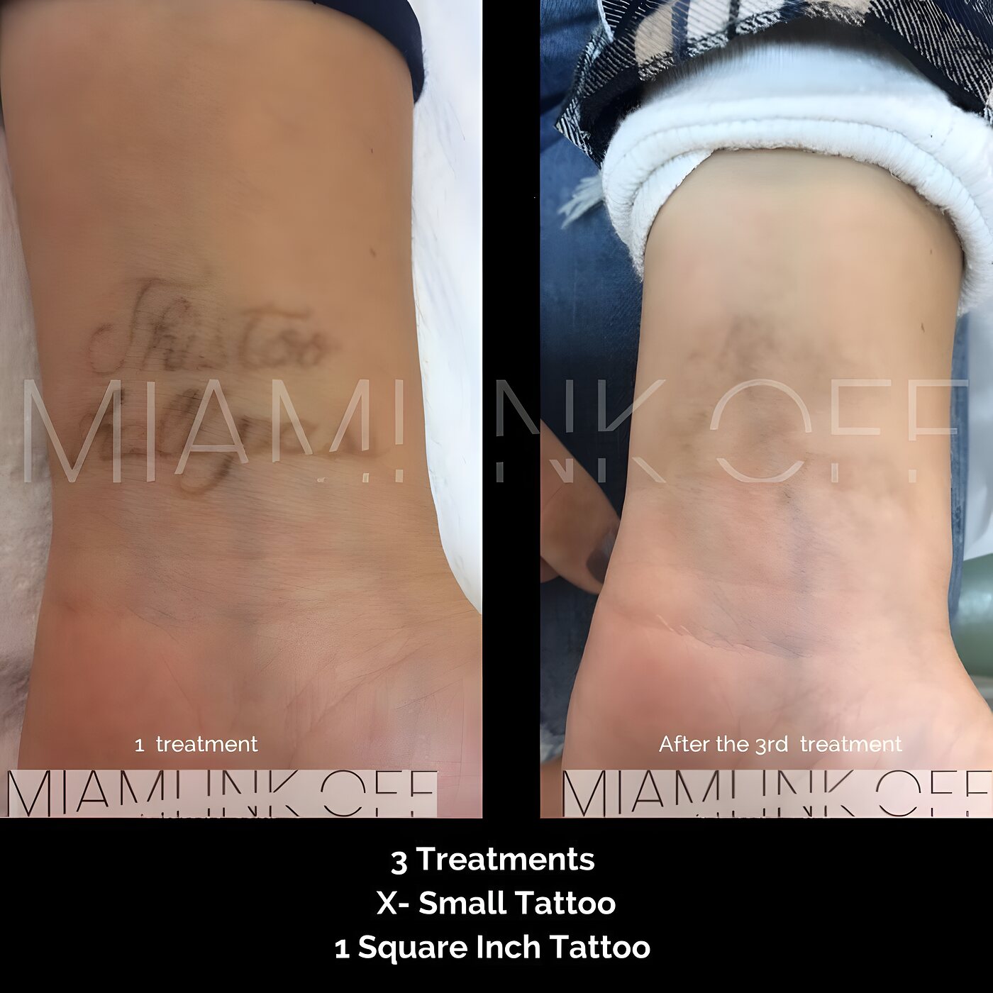Cursive wrist script tattoo faded after three laser tattoo removal sessions at Miami Ink Off, Brickell.