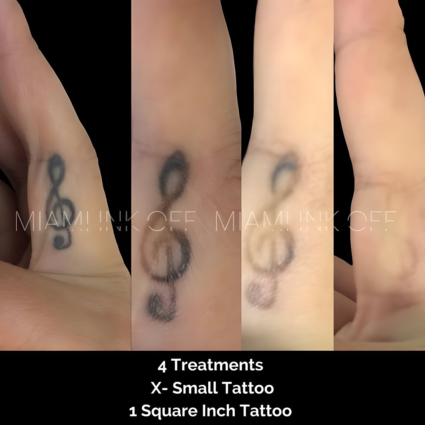 Treble clef wrist tattoo fading across four laser tattoo removal sessions at Miami Ink Off, Brickell.