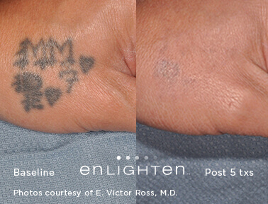 Before and after image of black ink tattoo laser tattoo removal after 5 treatment sessions with Enlighten III Laser - Miami Skin Spa