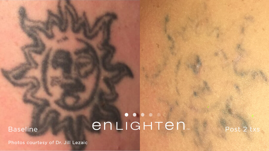 Before and after image of black ink tattoo laser tattoo removal of a sun after 2 treatment sessions with Enlighten III Laser - Miami Skin Spa