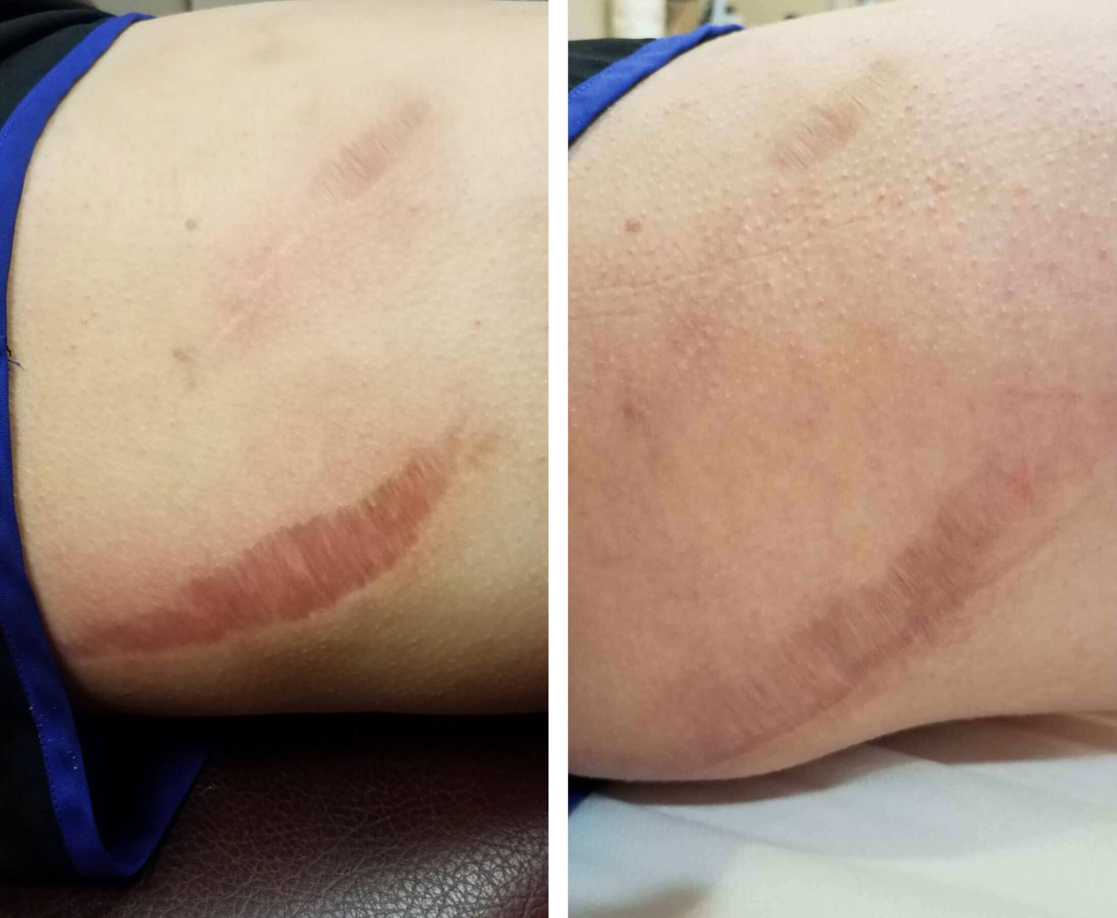 Before and after image of scar removal treatment after 1 treatment session - Miami Skin Spa