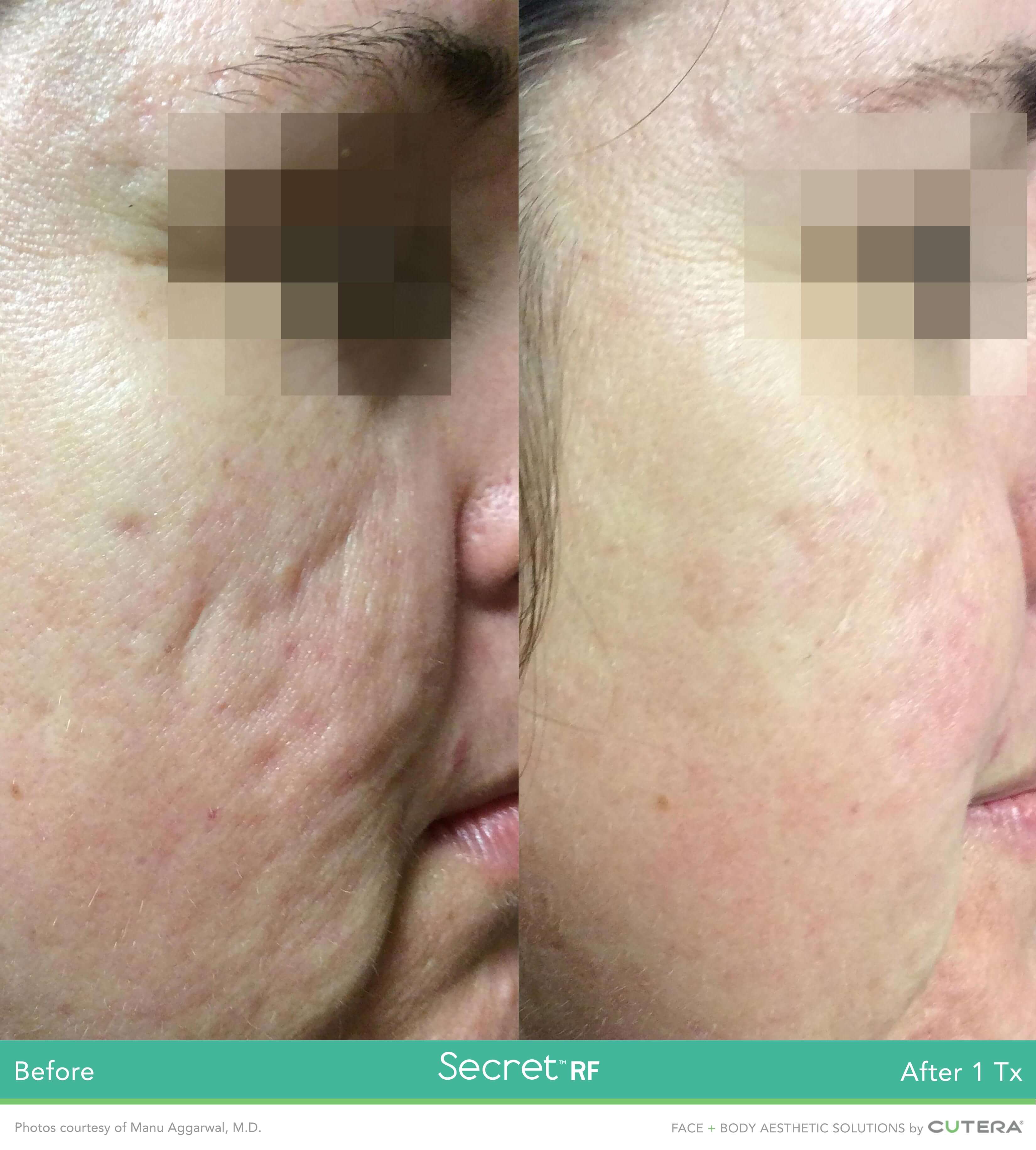 Before and after image of acne scar removal treatment after 1 treatment session with Secret RF- Miami Skin Spa
