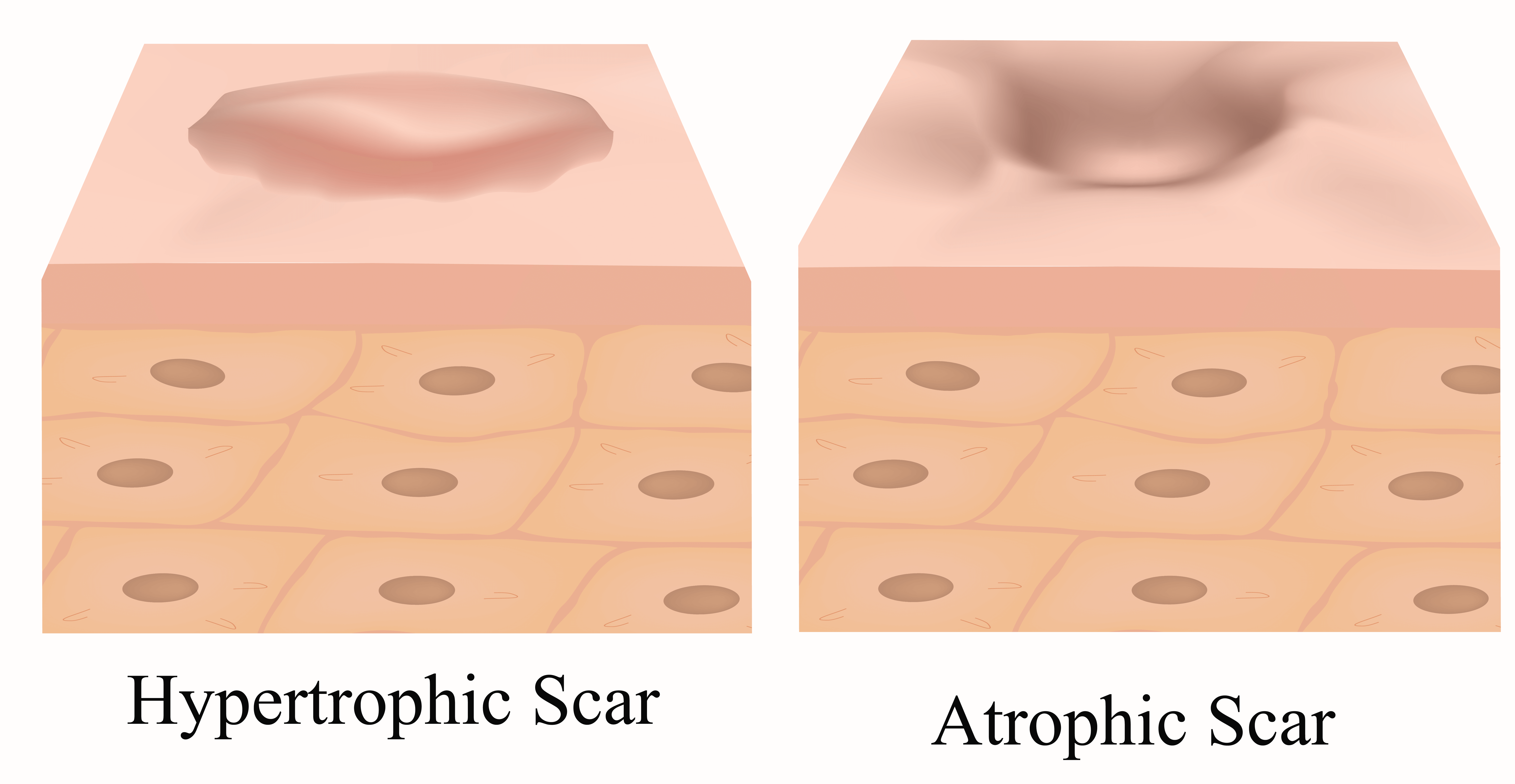 Type of Acne Scars - Hypertrophic Scar and Atrophic Scar