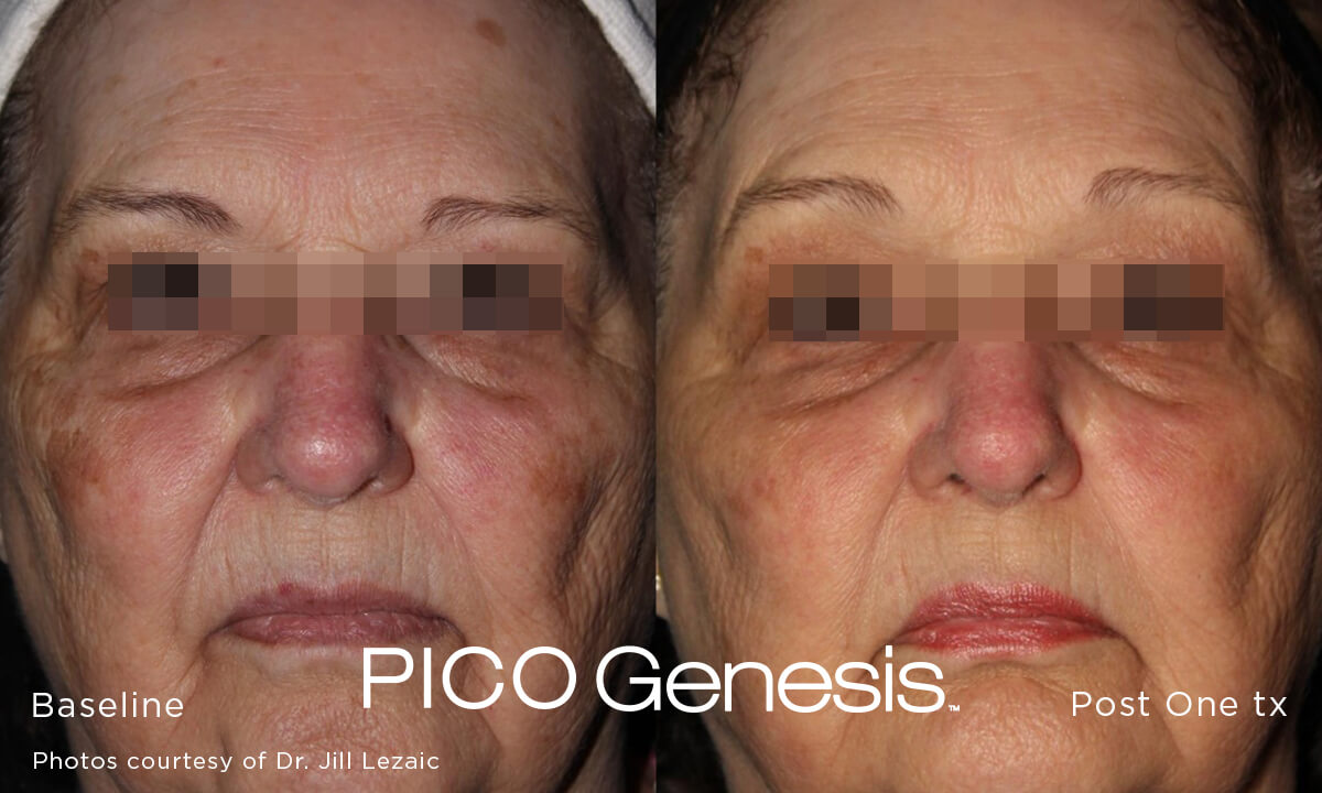 Before and after image of the pico genesis laser age spot removal treatment and brown spot removal treatment after 1 treatment