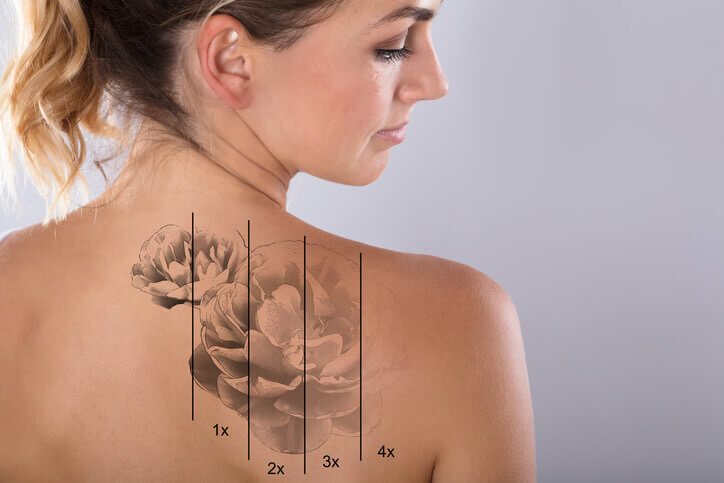 Laser Tattoo Removal | Fewer Treatments, Better Results | Miami Skin Spa
