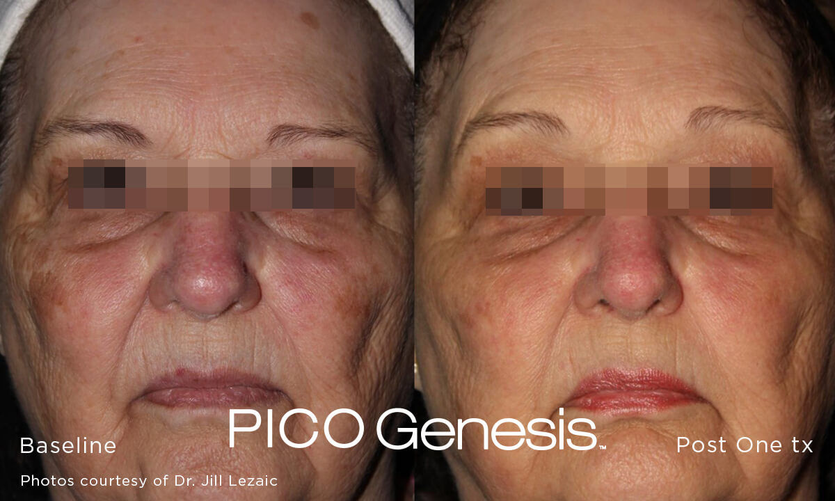Before and after image of melasma and brown spot removal treatment after 1 treatment session with pico genesis laser - Miami Skin Spa