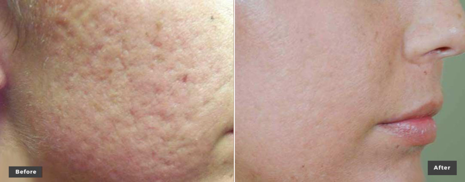 Laser Genesis before and after on the face