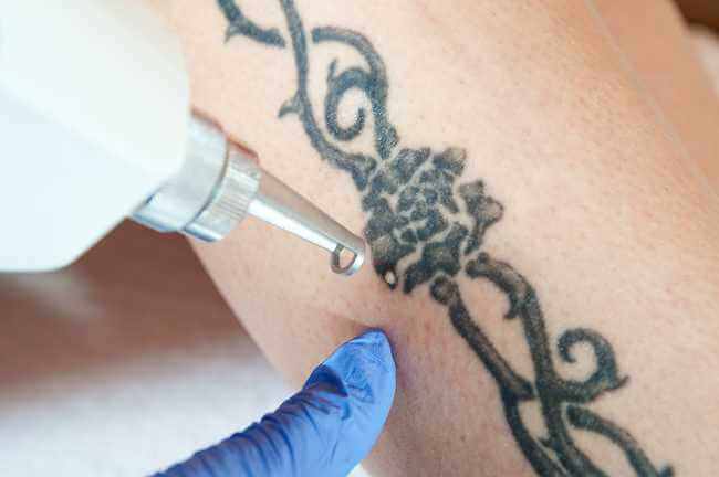 A tattoo on a patients arm being removed by a laser tattoo removal device
