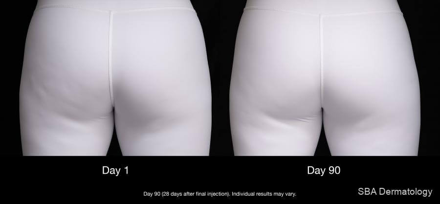A woman’s before and after picture taken with yoga pants on, with the 1st image taken on day 1 prior to her QWO cellulite treatment and the 2nd image 90 days after her QWO procedure.A woman’s before and after picture taken with yoga pants on, with the 1st image taken on day 1 prior to her QWO cellulite treatment and the 2nd image 90 days after her QWO procedure.