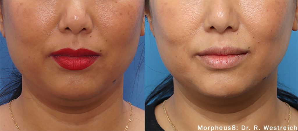 morpheus8-before-after-photo-miami-skin-spa-16