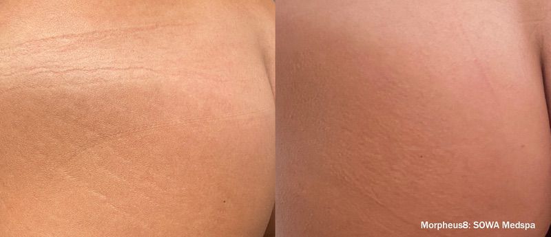 morpheus8 stretch mark removal before and after